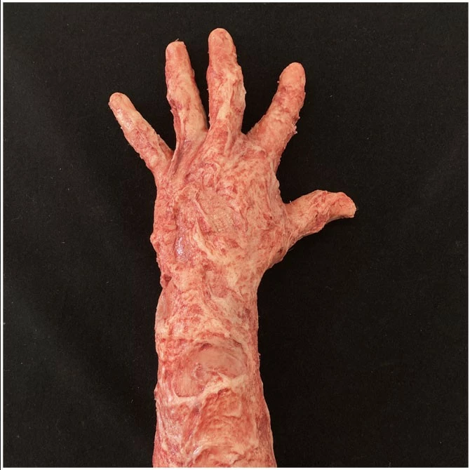 Other Silicone Burnt Arm - Image 3