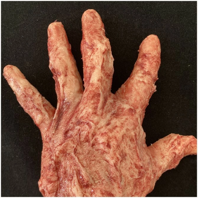 Other Silicone Burnt Arm